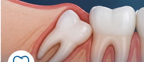 Wisdom Teeth Removal